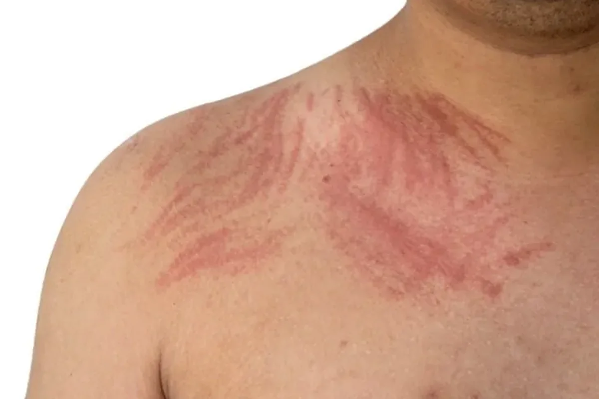 Dermografismo o urticaria facticia: qué es, causas y tratamiento