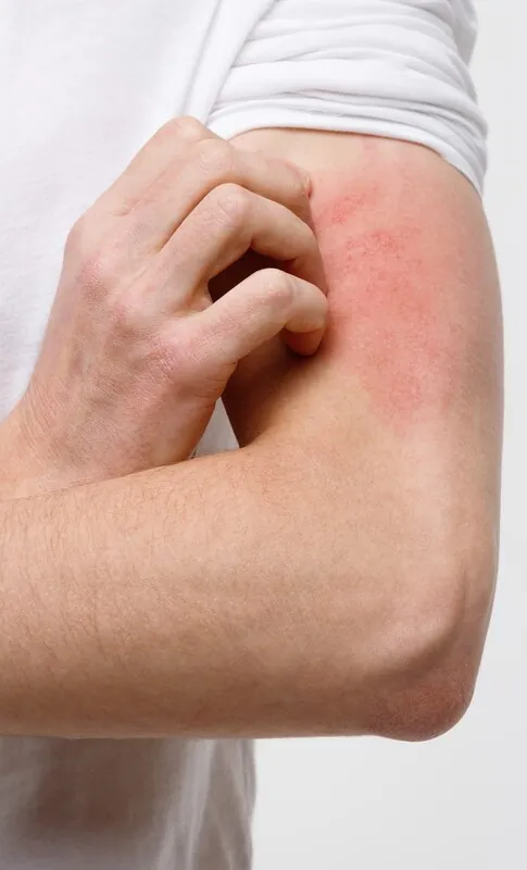 Urticaria y Angioedema